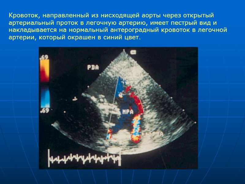 Кровоток, направленный из нисходящей аорты через открытый артериальный проток в легочную артерию, имеет пестрый